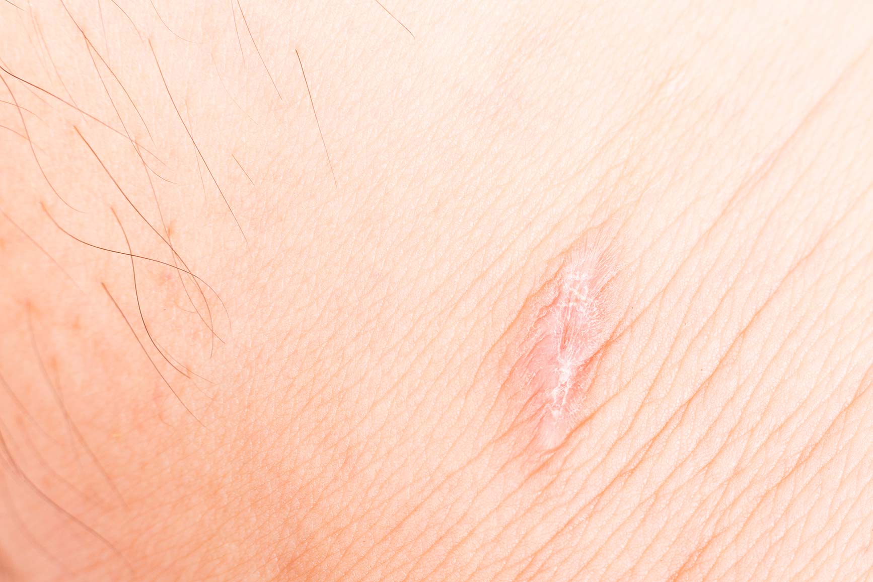 wound-care