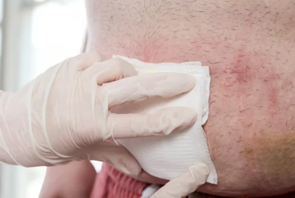 wound dressing